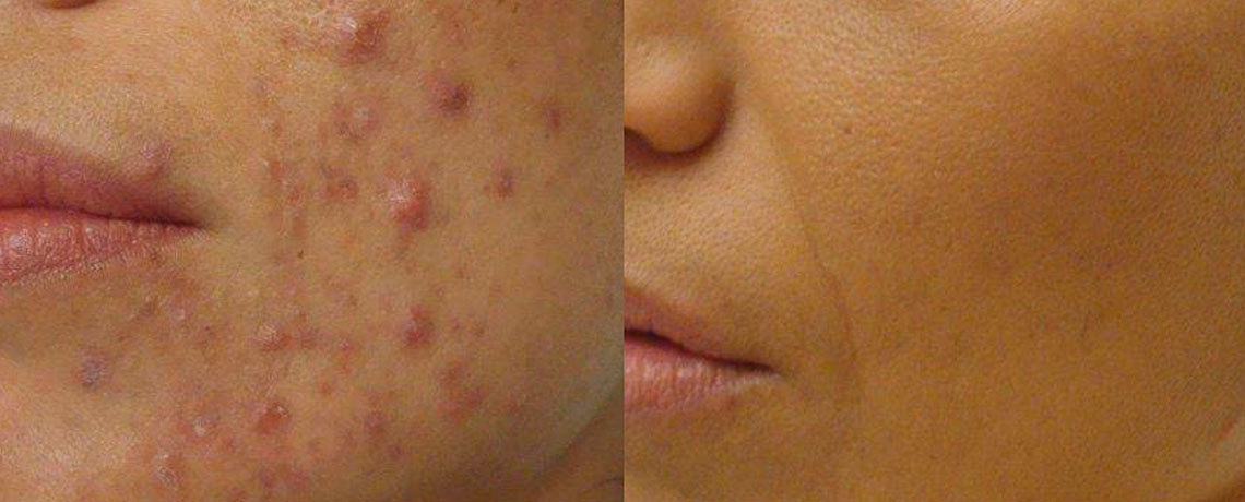 Acne