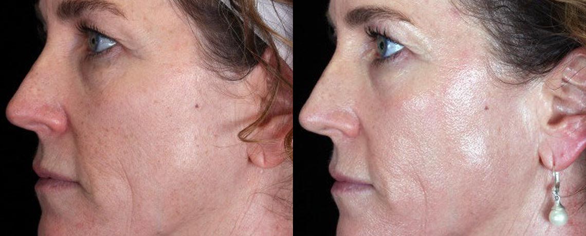 Facial Peels