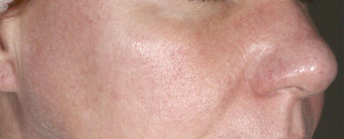 Redness / Rosacea