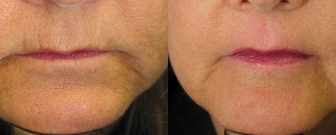 Skin Tightening
