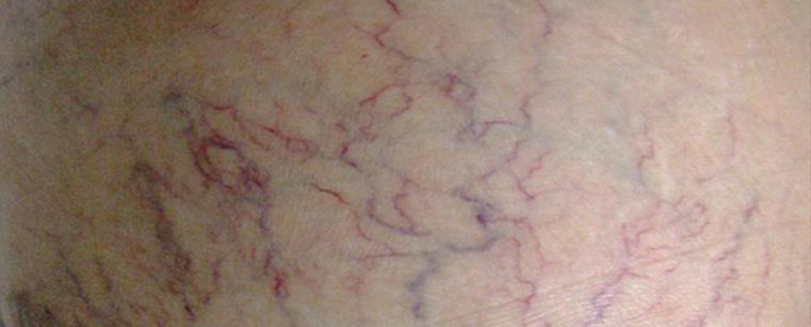 Spider Veins